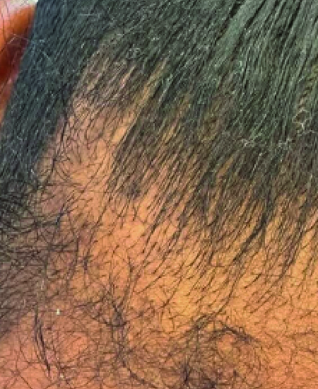 ANTES